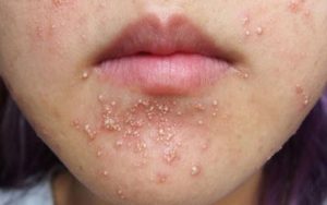 06 Bật Mí Chăm Sóc Nổi Mụn Nước Hiệu Quả Nhanh An Toàn.