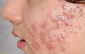 Mụn mủ hình thành do nhiều nguyên nhân khác nhau