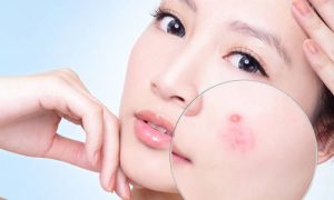 Mẹo Chăm Sóc Da Mụn Mủ Ở Da Khô Hiệu Quả Chuẩn Y Khoa