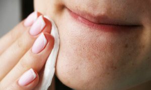 Bật Mí 7 Cách Chăm Sóc Da Mụn Đầu Đen Ở Cằm Cho Da Dầu