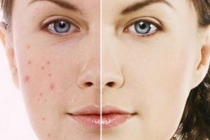 Chăm sóc da Mụn mủ ở da khô bằngThuốc tránh thai: