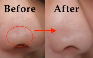 Bật mí cách chăm sóc mụn mủ da khô ở má hiệu quả nhanh vô cùng đơn giản mà không ai biết