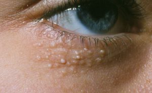 Điều trị mụn ẩn ở dưới mắt có gây nguy hiểm hay không