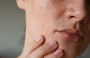 4 Cách Chăm Sóc Da Mụn Và Bít Tắc Lỗ Chân Lông Ở Da Khô Tại Nhà Dễ Dàng