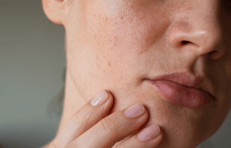 4 Cách Chăm Sóc Da Mụn Và Bít Tắc Lỗ Chân Lông Ở Da Khô Tại Nhà Dễ Dàng