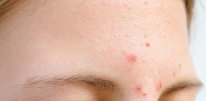 Cách chăm sóc mụn mủ da khô ở trán tại nhà phục hồi nhanh chóng không để lại thâm sẹo