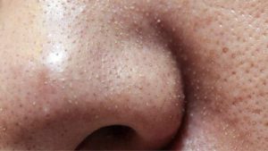 Top 4 Mẹo Chăm Sóc Da Sợi Bã Nhờn Vô Cùng Hiệu Quả, Đơn Giãn Tại Nhà