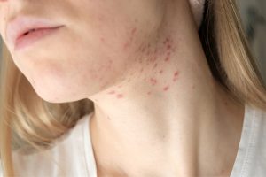 Bí Mật 8 Chăm Sóc Mụn Cho Da Khô Ở Cổ Hiệu Quả Nhanh Chóng