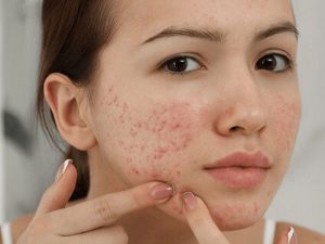 Điều Trị Mụn Ẩn Ở Dưới Da Không Đều Màu Trở Nên Trắng Sáng Sau 7 Ngày