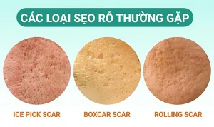 Cách Nhận Biết Các Loại Sẹo Thường Gặp