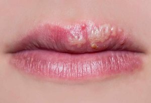 Cách Điều Trị Mụn Rộp Ở Môi Đơn Giản Và Phổ Biến Nhất Mà Bạn Chưa Biết Hiện Nay