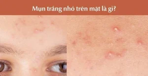 Cách Điều Trị Mụn Đầu Trắng Quanh Mặt Hiệu Quả Siêu Tốc Chuẩn Y Khoa