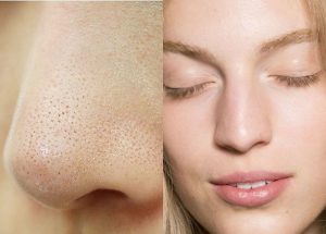 Mụn Cám Là Gì? Cách Điều Trị Mụn Cám Tại Nhà