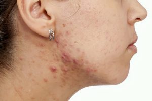 Điều Trị Mụn Ở Dưới Cổ Đúng Cách Hiệu Quả Không Gây Thâm Sẹo