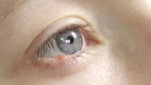 Điều Trị Mụn Nước Trên Mí Mắt An Toàn Đơn Giản Hiệu Quả Theo Các Bác Sĩ Da Liễu