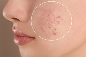 Điều Trị Mụn Đầu Trắng Và Bít Tắc Lỗ Chân Lông Tại Nhà Phục Hồi Nhanh Chóng