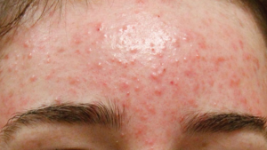 Điều Trị Mụn Bọc Ở Trán Có Điều Trị Khỏi Hay Không ?