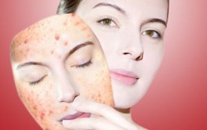 Điều Trị Mụn Bọc Sưng To Hiệu Quả Giảm Sưng Sau 24h