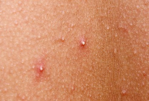 Điều Trị Mụn Đầu Trắng Hiệu Quả An Toàn Không Gây Thâm Sẹo