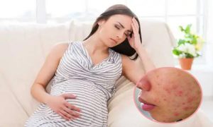 Điều Trị Mụn Thịt Ở Mẹ Bầu An Toàn Hiệu Quả Nhanh Theo Các Bác Sĩ Da Liễu Sau 1 Tuần