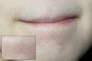 Điều Trị Mụn Ở Cằm Đơn Giản Hiệu Quả Không Gây Thâm