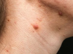 Điều Trị Mụn Mọc Ở Cổ Có Dễ Điều Trị Hay Không ?