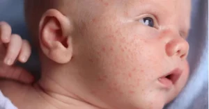 Cách Điều Trị Mụn Thịt Trên Mặt Trẻ Sơ Sinh Đơn Giản