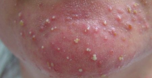 Điều Trị Mụn Đầu Trắng Có Mủ Không Gây Thâm Sẹo