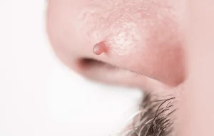 Cách Điều Trị Mụn Thịt Ở Mũi Hiệu Quả Nhanh Ít Tốn Kém Tại Nhà